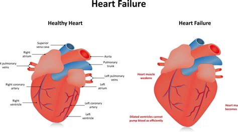 hypokinesis of heart wall treatment.